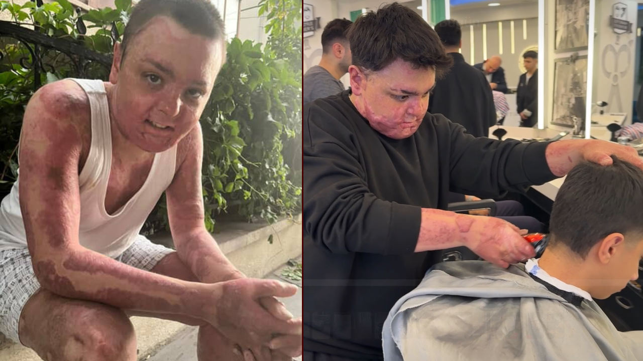 65 ameliyat geçirdi, 12 gün uyutuldu! Yangının ardından yaşadığı kabusu anlattı