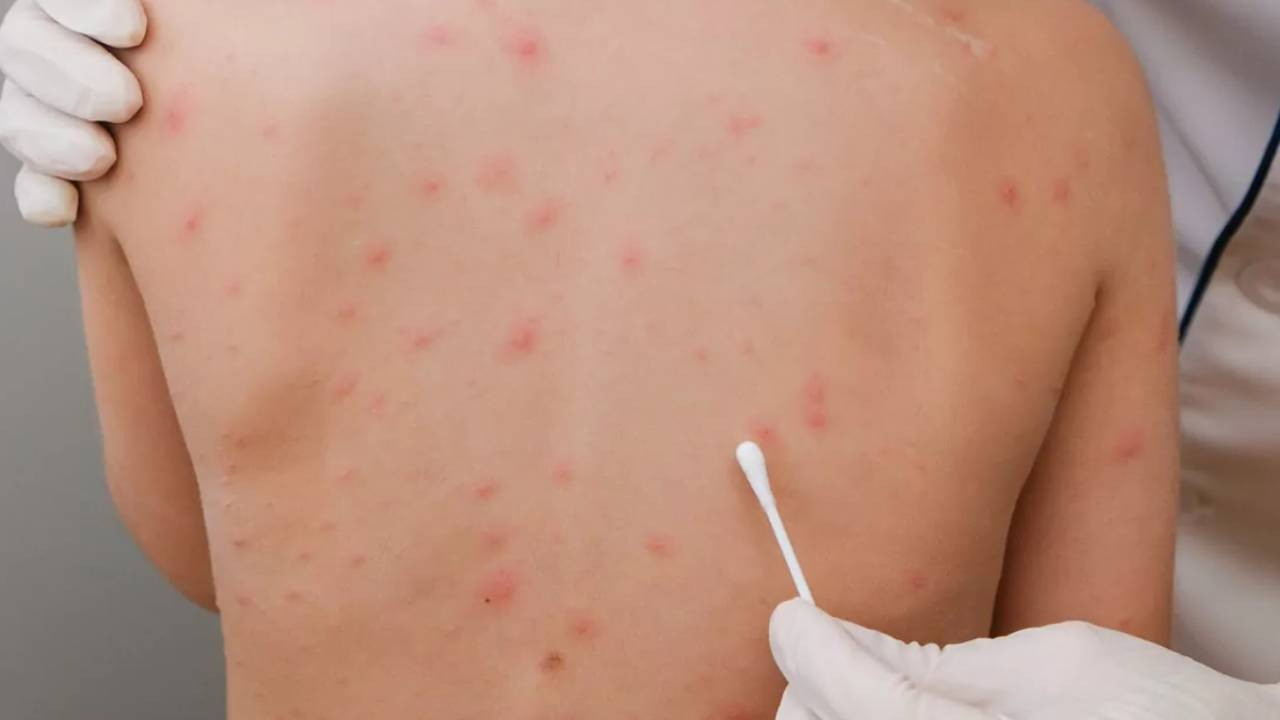 Bu belirtiler varsa dikkat! O hastalıkta dikkat çeken artış yaşanıyor