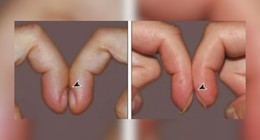 Hemen parmaklarınızı kontrol edin: Parmaklarda ortaya çıkan bu belirti o hastalığın habercisi olabilir