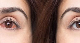 Sürekli gözünü kaşıyanlar dikkat! O hastalığı tetikliyor ve gençlerde görme kayıplarına neden oluyor: Keratokunus hastalığı nedir nasıl tedavi edilir?