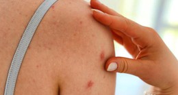 Bikini sezonu açılmadan önleminizi alın: Sırt ve omuz bölgesindeki sivilceleri yok etmenin sırrı bulundu. İşte sivilceleri kurutmaya yardımcı olan o yöntem