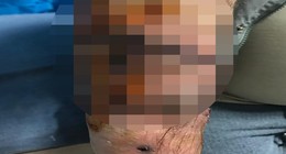 Köpekler dehşet saçtı! Parça parça ettiler. Koluna 40, bacağına 36 dikiş atıldı