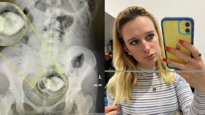 Cinsel ilişki oyuncağı makatına kaçan kadın hastanelik oldu