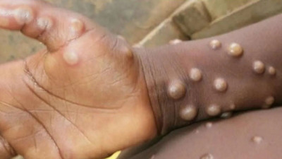 Maymun çiçeğiyle ilgili DSÖ'den korkutan açıklama. Dünya Sağlık Örgütü açıklama yaptı ve  11 ülkede teyit edilmiş 80 vaka olduğunu belirtti. DSÖ vaka artışı konusunda ise uyarıda bulundu