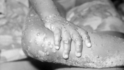 Maymun çiçeği cinsel yolla mı bulaşıyor. Maymun çiçeğine yakalanmamak için cinsel ilişkide korunma önemli mi. Maymun çiçeği nedir. Maymun çiçeğinin tedavisi var mı?