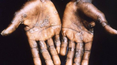 Dünya Sağlık Örgütü’nden maymun çiçeği hastalığı açıklaması: Nasıl bulaştığını duyurdular