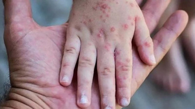 Türkiye'de ilk maymun çiçeği vakası görüldü! Sağlık Bakanı Fahrettin Koca duyuru