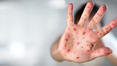 Dünya Sağlık Örgütü'nden flaş maymun çiçeği kararı: 'Kürüsel acil durum' ilan edildi