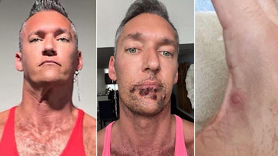 Maymun çiçeği virüsü bulaşan adam yaşadıklarını ağlayarak anlattı