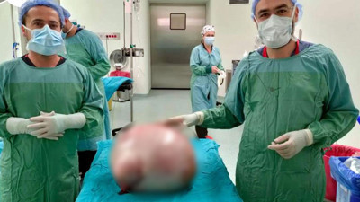 Şişkinlik şikayetiyle doktora başvurmuştu. Karnından çıkan kitle ağızları açık bıraktı: Tam 35 kilo, ilk kez bu kadar büyük bir kitle ile karşılaştık