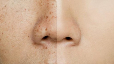 Yaz bitti etkisi bitmedi! Malezma hastalığından yakınanlar çoğaldı. Malezma nasıl geçer? Nedir bu malezma hastalığı? Güneş lekelerine çözüm var mı tedavi edilebilir mi? Malezma güneş lekesi hastalığı mı?