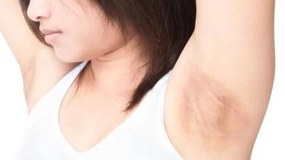 Kararmış koltuk altına elveda: Kararan koltuk altı nasıl beyazlar?