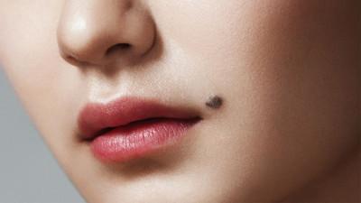 Ben lekelerini silgi gibi temizleyen yöntem bulundu: Suda bekletip sürünce benlerden eser kalmıyor. Ben nasıl geçer?