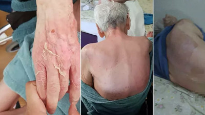 Huzurevindeki ölümde beklenen rapor geldi! İddiaların tam tersi çıktı: 86 yaşındaki kadının ölüm nedeni yanık!