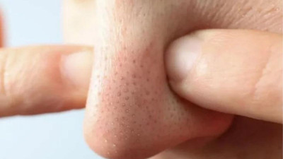 Burun üstündeki siyah noktaları tek seferde yok ediyor: Burnunuz tertemiz olacak. İşte burun üstündeki siyah noktaları yok eden o etkili formül