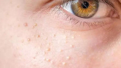 Bu görüntüden kurtulmanın formülü bulundu: Göz altındaki inatçı yağ bezelerinden doğal yollarla kurtulmak mümkün