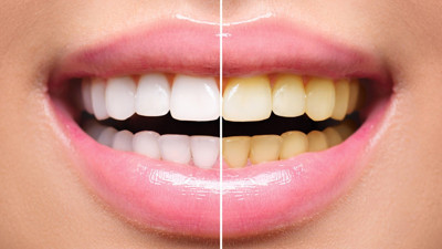 Sararmış dişleri bembeyaz yapan karışım bulundu: Dişleri inci gibi beyazlatmanın sırrı bu karışımda. Diş nasıl beyazlatılır?