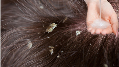 Saç derisinde ne kepek ne pullanma bırakıyor: Şampuanın içine 3 tane ilave etmeniz yeterli. Kepeğe ne iyi gelir?