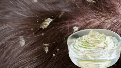 Saç derinizde ne kepek ne kaşıntı kalacak: Tek bir uygulamayla saç deriniz rahatlayacak. Kepek ve kaşıntıya doğal çözüm bulundu