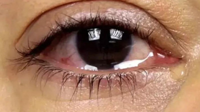 Göz sulanmasını sakın hafife almayın: Altında ciddi sorunlar yatıyor olabilir. Polen alerjisi deyip geçmeyin