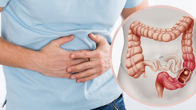 Kolon kanserine kalkan olan o besin bulundu: Kolon kanserine karşı nasıl beslenmeli?