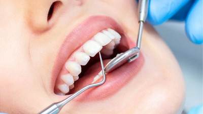 Oruçluyken diş çektirmek orucu bozar mı, Diş tedavisi yaptırmak orucu bozar mı? Diyanet'ten açıklama geldi