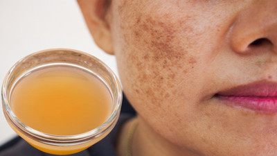 Güneş lekelerine doğal formül bulundu: 1 damlasıyla güneş lekelerinden eser bırakmıyor. Güneş lekeleri evde nasıl geçer?