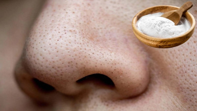 Siyah noktaları vakum gibi çeken yöntemmiş: Karbonatla karıştırınca siyah noktalardan eser kalmayacak. Siyah noktalar nasıl geçer?