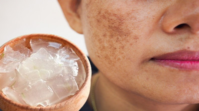 Güneş lekelerini yok eden formül bulundu: Sadece tek bir ürünle kesin çözüm mümkün. Doğal yolla güneş lekeleri nasıl geçer?