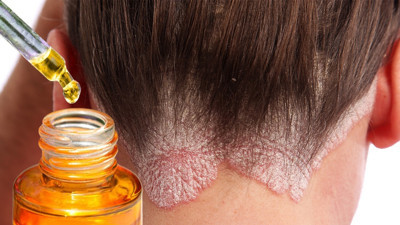 Saçtaki egzamayı kökten bitiren yağ bulundu: Kaşıntı, pullanma ve kızarıklık son bulacak. Saç egzamasına hangi yağ iyi gelir?