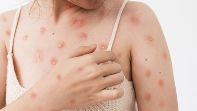 Yeni salgın tehlikesi. Çok hızlı yayılıyor. En tehlikeli varyant. Cinsel yolla yayıldı. Ten tene değince bulaşıyor. Ölümler var