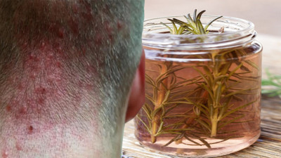 Saç kökündeki iltihabı kurutuyor: Tek 1 damlası yetiyormuş. Saç kökü iltihabı nasıl geçer?