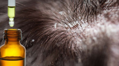 Şampuana birkaç damla ekleyin kepekten kurtulun: Saçtaki kepeği kökten bitiren formül bulundu. Saçtaki kepek evde nasıl geçer?