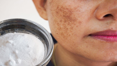 Karbonatla karıştırıp sürün güneş lekelerinden kurtulun: Güneş lekelerine doğal formül bulundu. Güneş lekeleri en hızlı nasıl geçer?