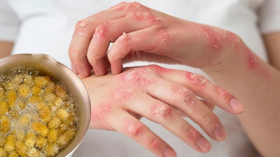 Ilık suya katıp elinizi bekletin egzamadan kurtulun: Eldeki egzamaya doğal formül bulundu. Eldeki egzamaya evde ne iyi gelir?