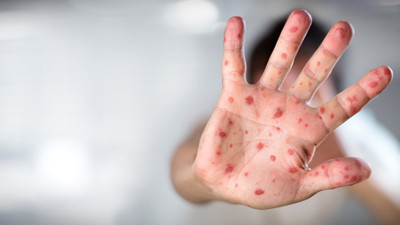 Maymun çiçeği virüsü Türkiye'ye sıçradı. Prof. Dr. Önder Ergönül canlı yayında açıkladı