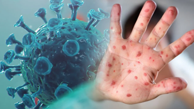 FLAŞ! Türkiye'de M Çiçeği (Maymun Çiçeği) görüldü mü? Sağlık Bakanlığı son dakika açıklaması yaptı