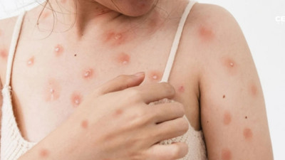 Sakarya’da ‘Maymun çiçeği’ vakası görüldüğü iddialarına yanıt!