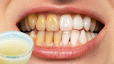 Dişleriniz 2 malzemeyle 2 dakikada bembeyaz olacak: Limon suyuyla karıştırıp fırçalamak yetiyormuş. Sararmış dişler nasıl beyazlar?