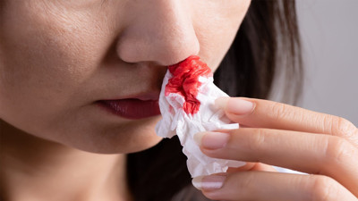 Basit bir burun kanaması diye sakın geçiştirmeyin: Ardında tehlikeli hastalık yatıyor olabilir. Burun kanaması ne zaman tehlikelidir?