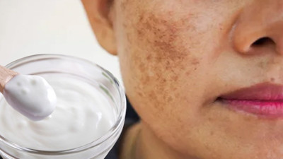 Yoğurtla karıştırıp sürün güneş lekelerinden kurtulun: Lekelerden eser kalmayacak. Ciltteki güneş lekeleri nasıl yok edilir?