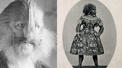 Hipertrikoz (Ambras sendromu) nedir, belirtileri nelerdir? Hipertrikoz nedenleri neler, tedavisi var mı?