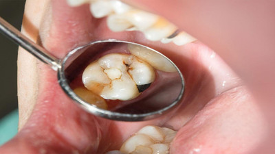 Diş çürüklerini önleyen yöntemler ortaya çıktı: Diş çürümesini ne durdurur?