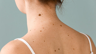 Hemen benlerinizi kontrol edin: Kanserli benlerin bu belirtilerine dikkat