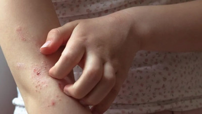 Çocuklarda kaşıntı neyin belirtisi olabilir, deride döküntü neden olur?