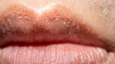 Hem genital bölgede hem de dudaklarda görülüyor: Bu lekelere aman dikkat