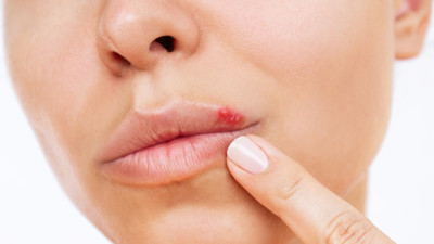 Basit bir uçuk deyip geçmeyin: Geri dönüşü olmayan durumlara neden olabilir