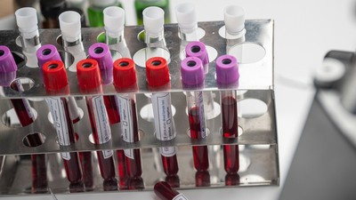 Erken yaşta Alzheimer'a yakalanan kan grupları belli oldu