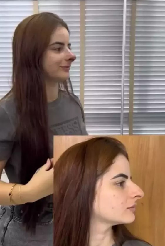 Burun estetiği yaptırdı, son halini görenler şaştı kaldı!