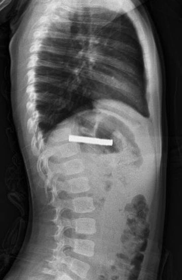 Elazığ'da akıl almaz olay! 3 yaşındaki çocuğun yemek borusundan çıkanlar şaşırttı